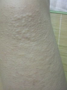 医生正在给患者查看荨麻疹病情