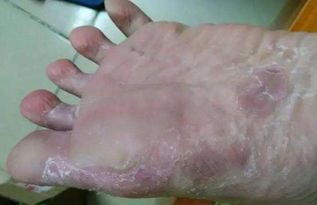 内裤袜子混洗，脚气真菌竟能传到面部？太可怕！