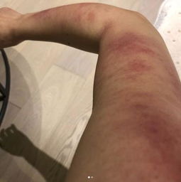 受伤孩子的手臂青紫淤血