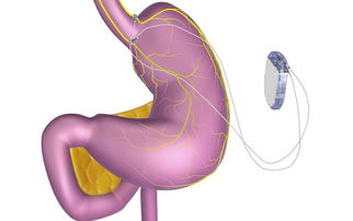 26岁就确诊胃癌？这些早期信号别忽视！