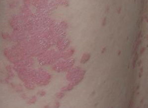 长期焦虑竟引发身体炎症？这是我亲身经历的真实故事