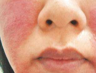 一位女士满脸红肿坐在镜子前查看自己皮肤状况