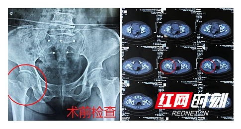 全球罕见！'身首离断'患者竟被中国医生救回