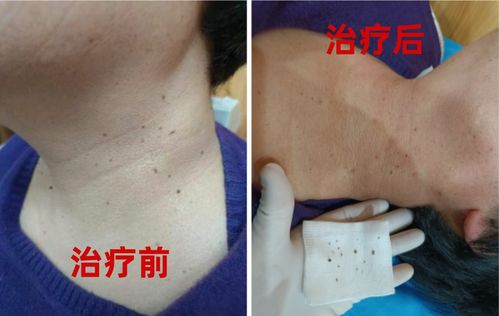 身上长有巨大疣体的鹿