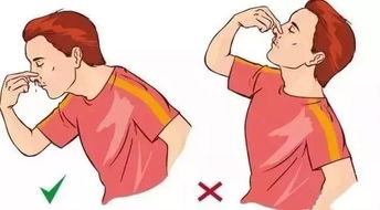 流鼻血仰头止血？快停下，这可是很危险的做法！