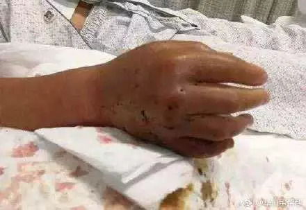 云南老人被蛇咬伤现场