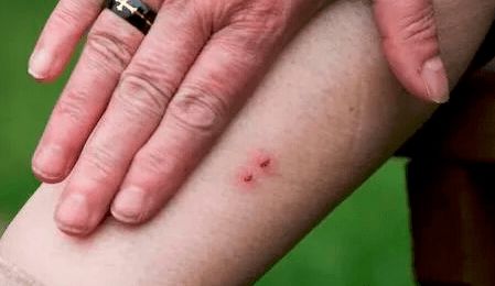 多种毒蛇咬伤伤口对比