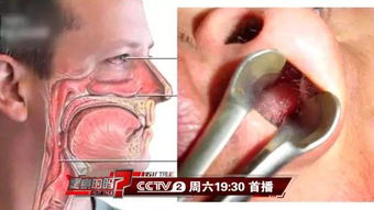 爸爸掏耳朵遇险，耳膜差点就没了！