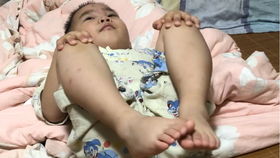 自闭症患者何去何从？能力退化需终身照护令人揪心