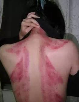 女子刮痧虚构遭老公殴打被罚：背后真相令人深思