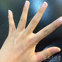 手部竟藏着这3种癌症预警？快看看你的手！